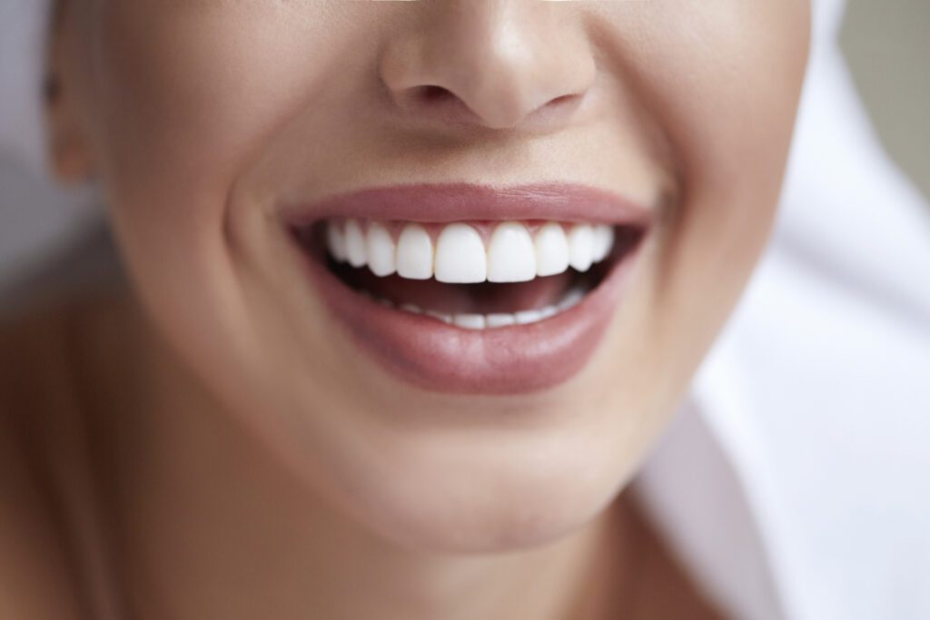 Dental Veneers in Dallas, TX